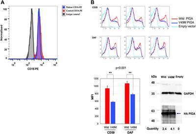 Case report: Functional characterization of a de novo c.145G>A p.Val49Met pathogenic variant in a case of PIGA-CDG with megacolon